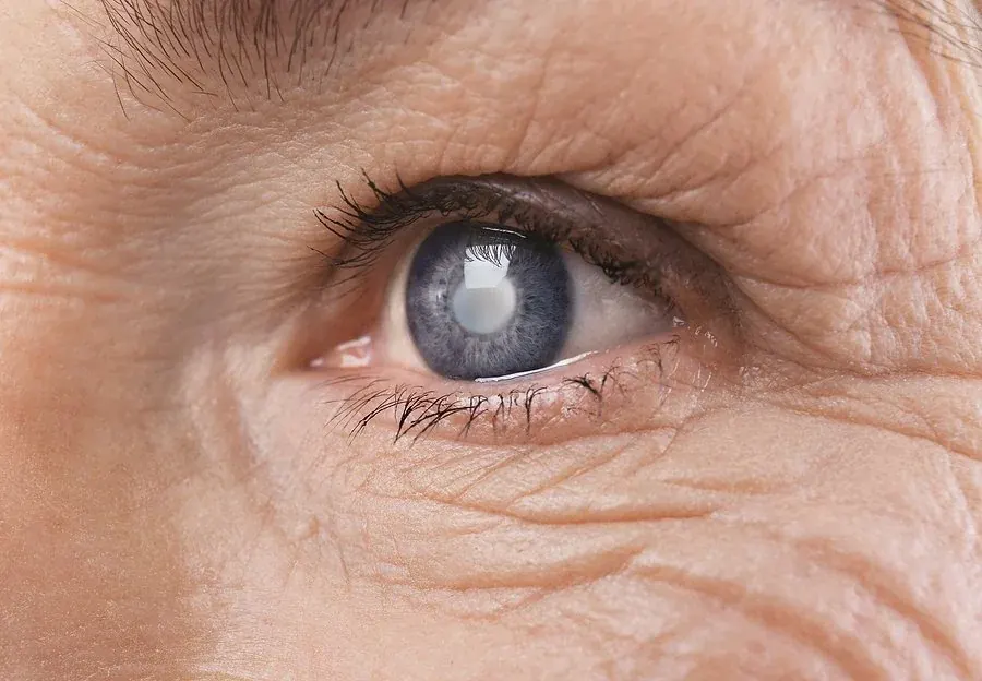 An older woman with cloudy vision