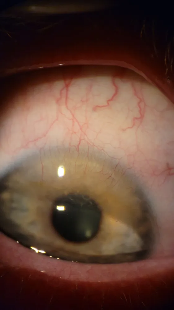 Corneal neovascularization from contact lenses