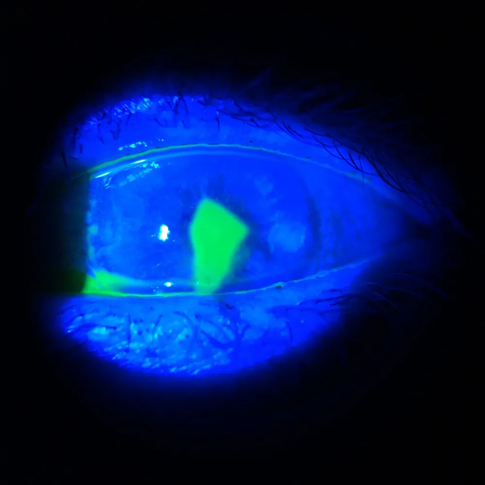 A corneal abrasion from eyelash-extension glue