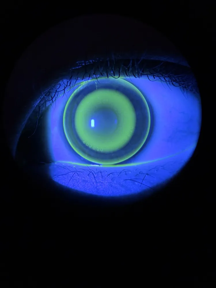 An ortho-k lens on the eye