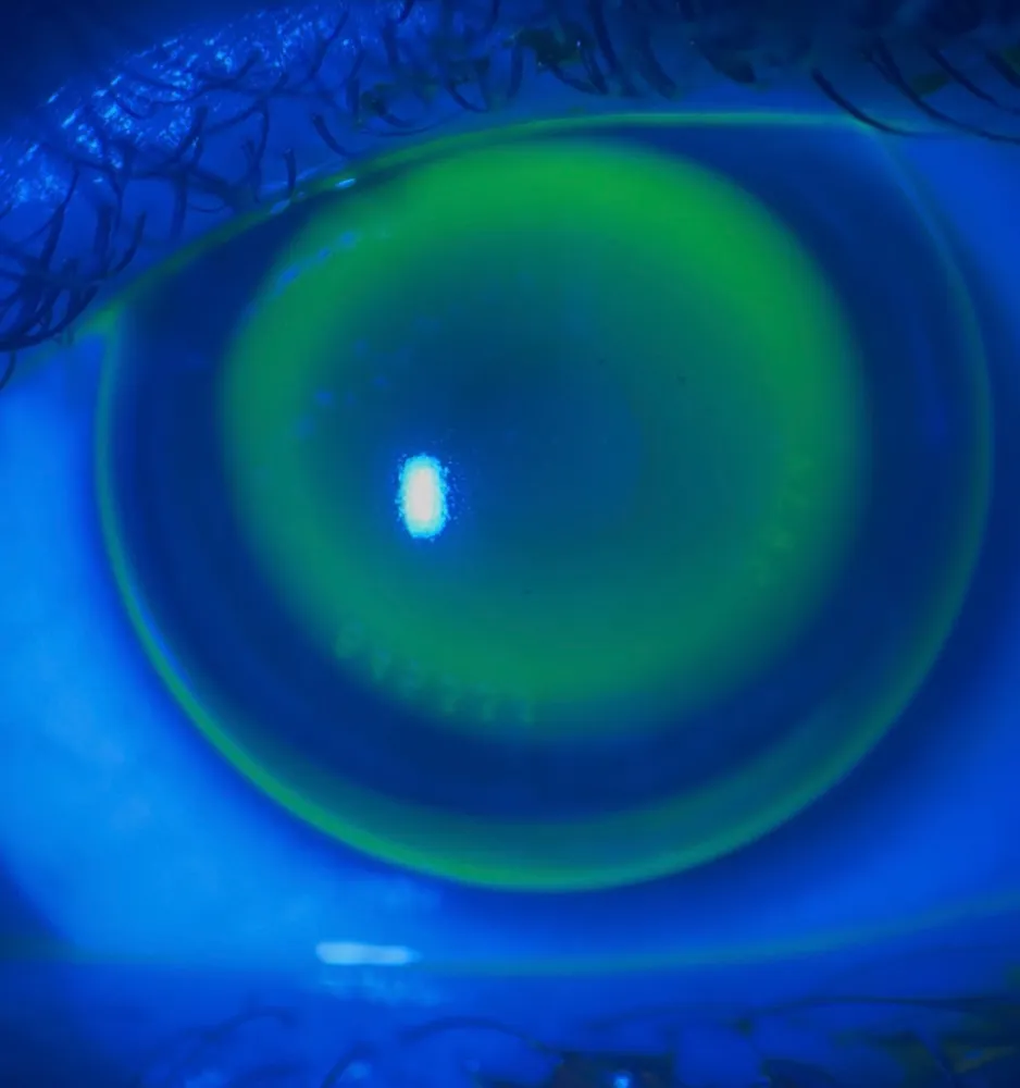 The ortho-k bull’s-eye pattern