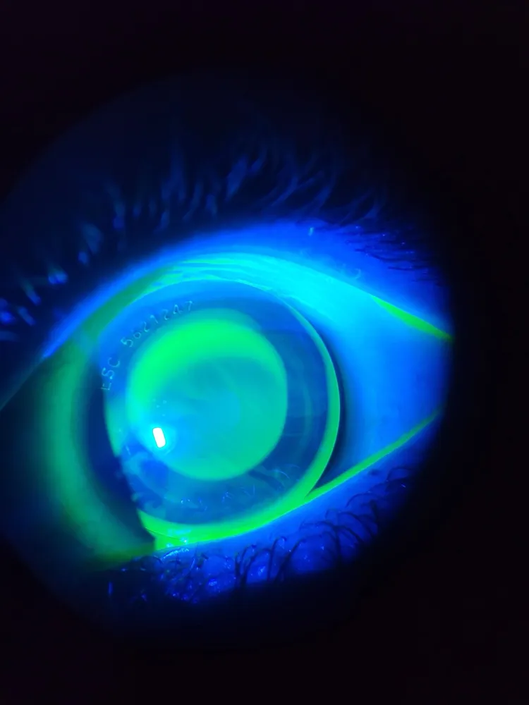 A rigid gas permeable lens fit checked with fluorescein dye