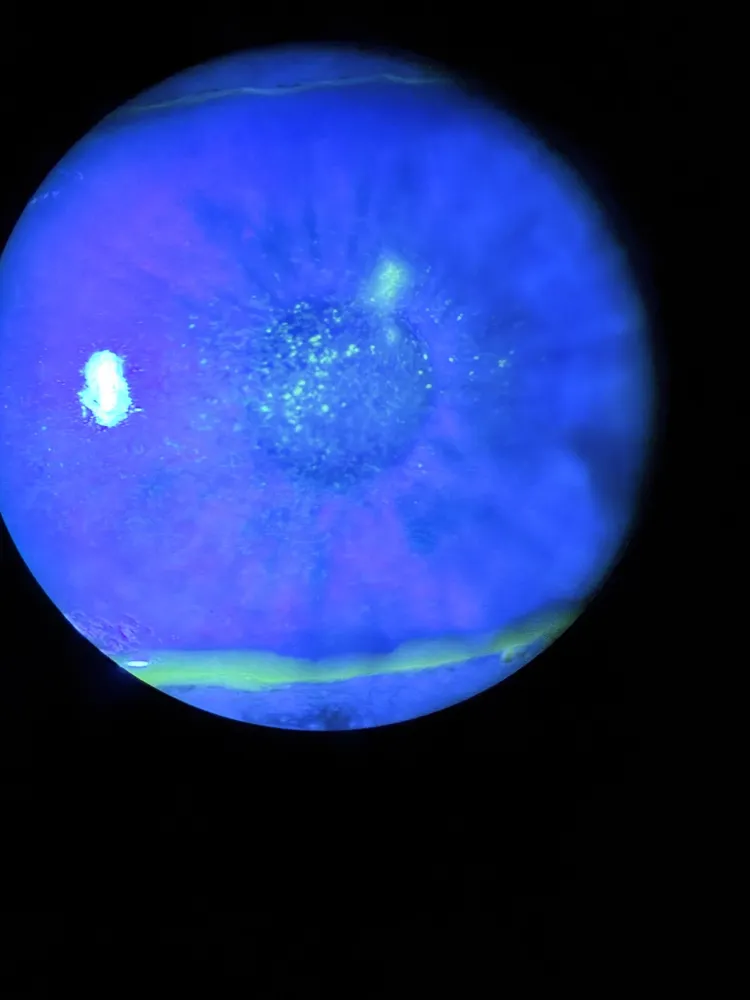 SPK on the cornea