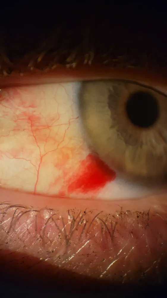 A subconjunctival hemorrhage
