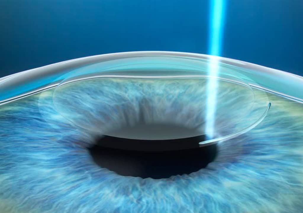 Small incision lenticule extraction (SMILE)