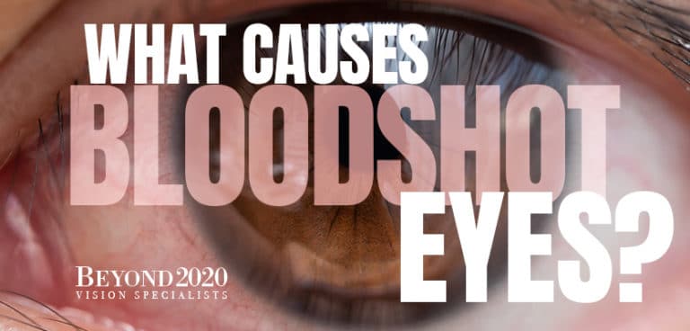 What Causes Bloodshot Eyes? - Beyond 2020 Vision Specialists