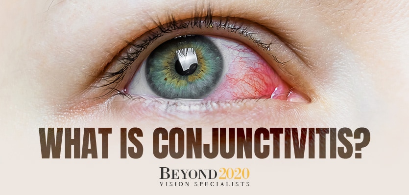 Conjunctivitis, also known as pink eye. What is it?